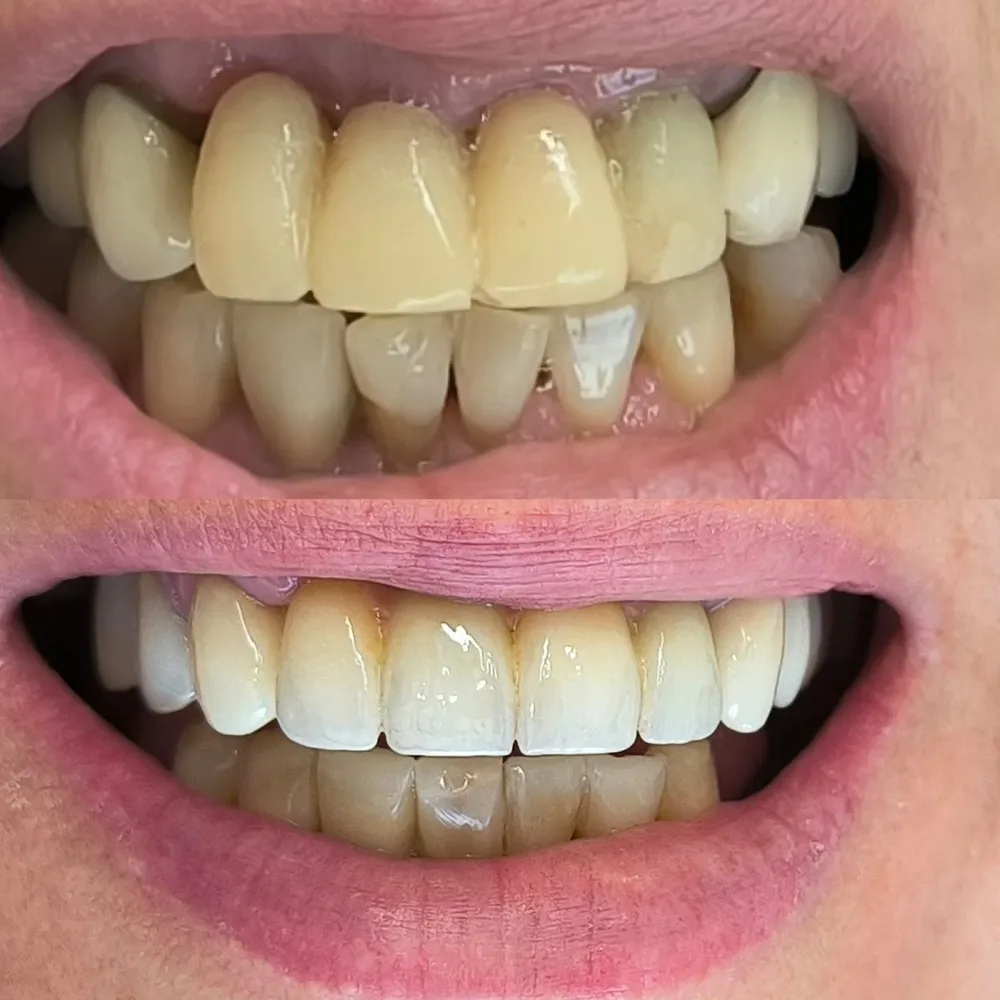 Clínica Dental Dr. Andrés Schlosser: Rehabilitación Oral-Odontología Digital-Implantes-Diseño Sonrisa
