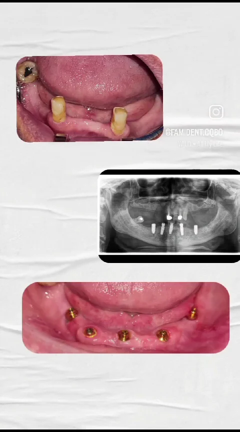 Ortodoncia Famident - Prótesis dentales - Exodoncias - Extracciones dentales